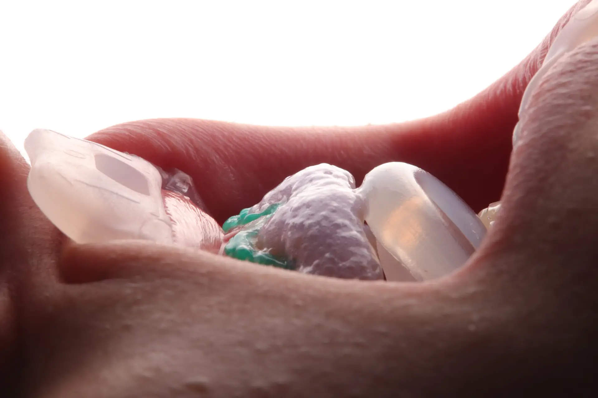 Blanqueamiento dental clínico — protocolo de cambio de color