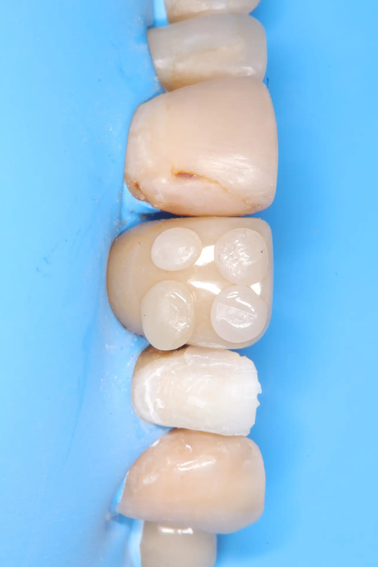 Resinas Directas Dr. Nicolas Mora odontología