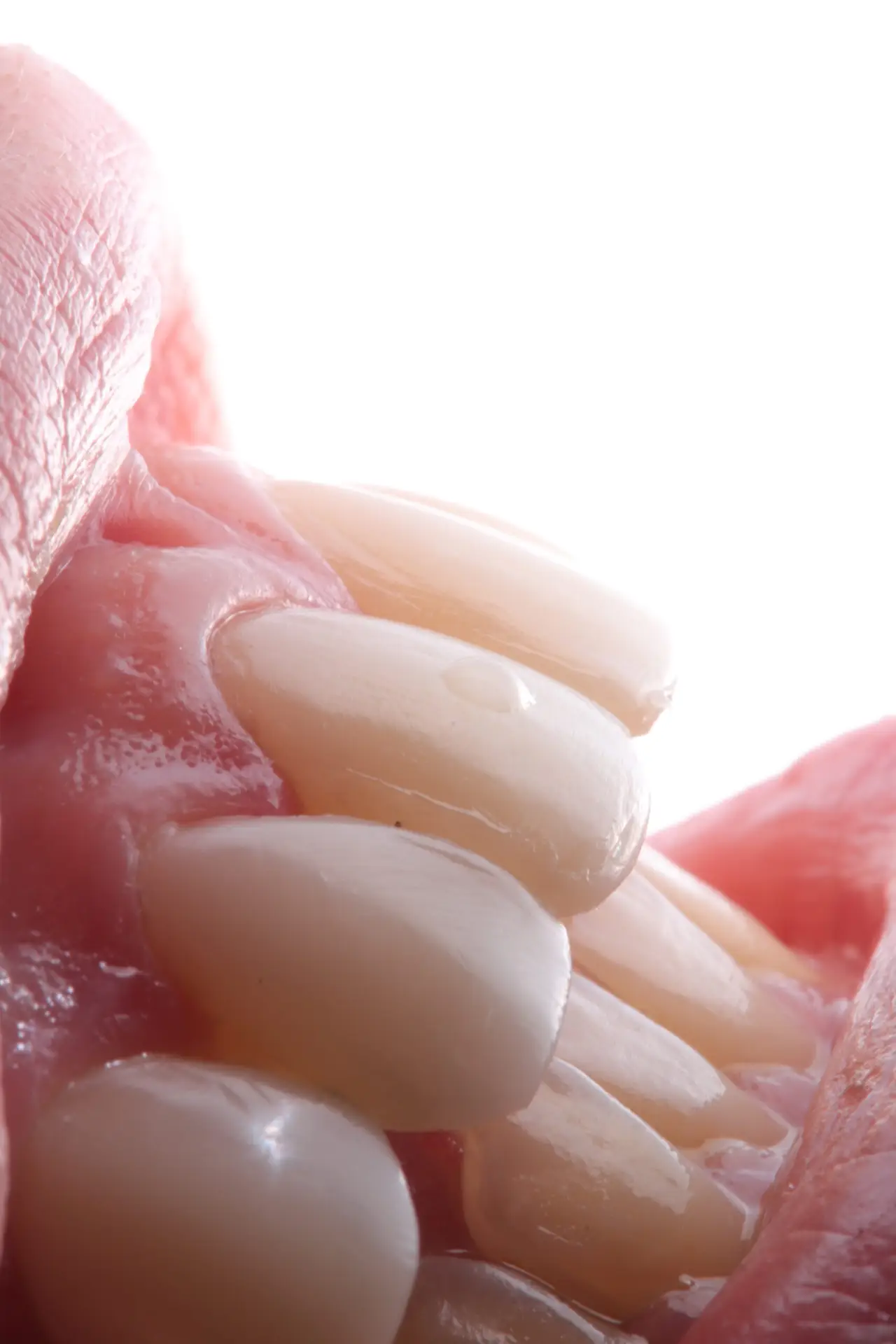 Carillas esteticas de resina dr. nicolas mora