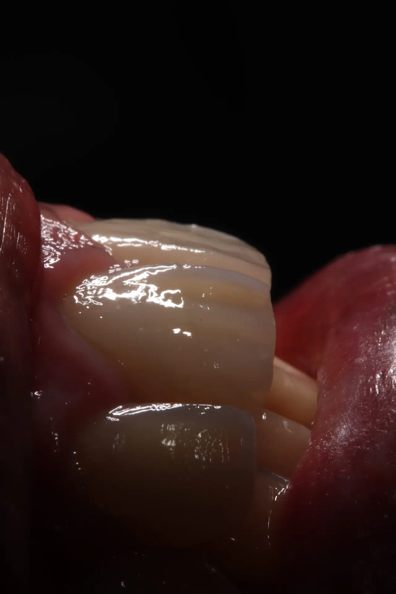 Caso B — Restauración adhesiva estética, fotografía clínica macro